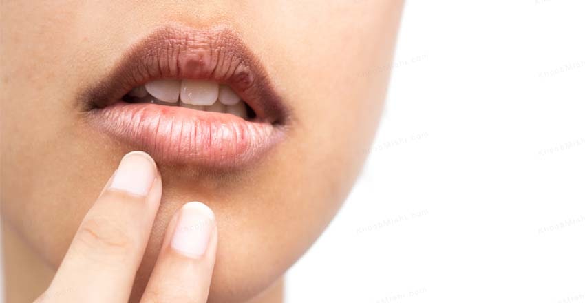 علت خشکی دهان چیست + درمان قطعی خشکی دهان